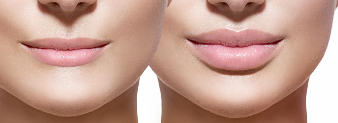 Lip Fillers - Restore Lip Volume - Aesthetics Medical Group